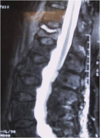 acute vertebral fracture.jpg